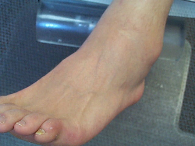 Acute ankle sprain